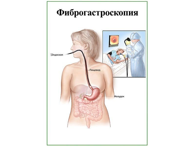 OLD Фиброгастроскопия, плакат глянцевый А1/А2 (глянцевый A2)