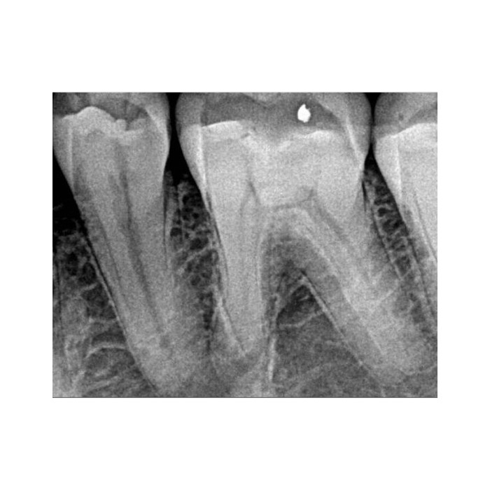Carestream Dental RVG 5200 - радиовизиограф, 16 пар линий/мм