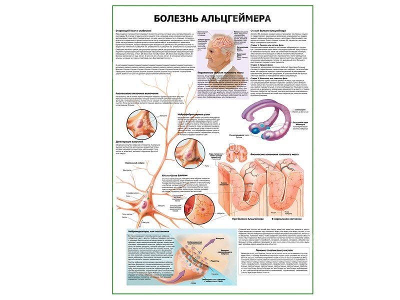 OLD Болезнь Альцгеймера плакат глянцевый А1/А2 (глянцевый A1)