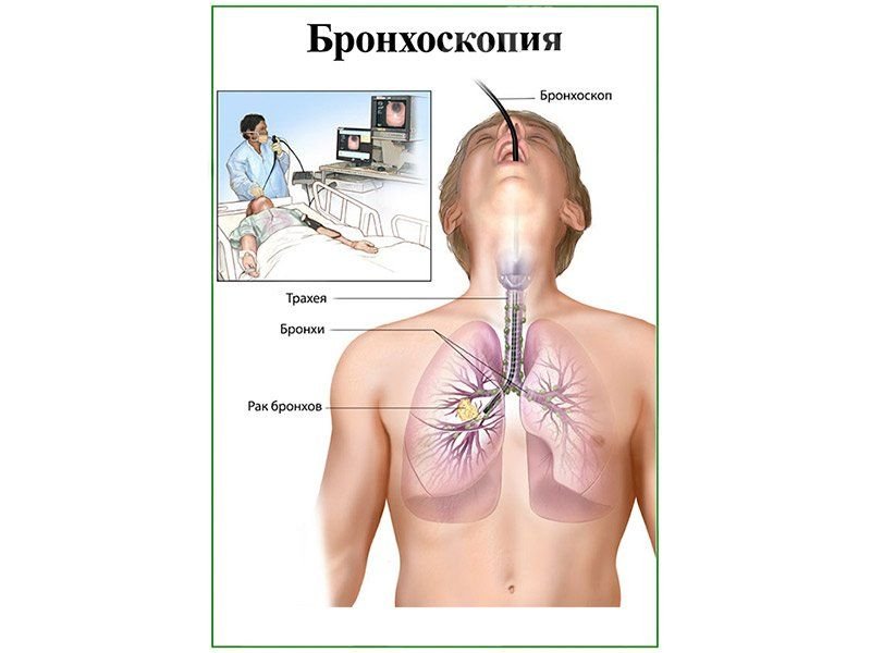 OLD Бронхоскопия, плакат глянцевый А1/А2 (глянцевый A1)