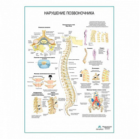 Нарушения позвоночника плакат глянцевый А1+/А2+ (глянцевая фотобумага от 200 г/кв.м, размер A2+)