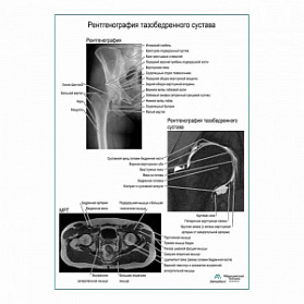 Рентгенография тазобедренного сустава плакат глянцевый А1+/А2+ (глянцевая фотобумага от 200 г/кв.м, размер A1+)