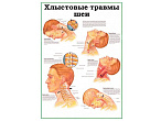 OLD Хлыстовые травмы шеи, плакат глянцевый  А1/А2 (глянцевый A1)