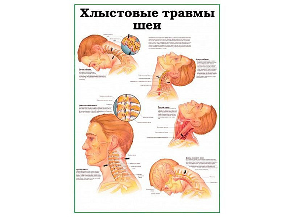 OLD Хлыстовые травмы шеи, плакат глянцевый  А1/А2 (глянцевый A2)