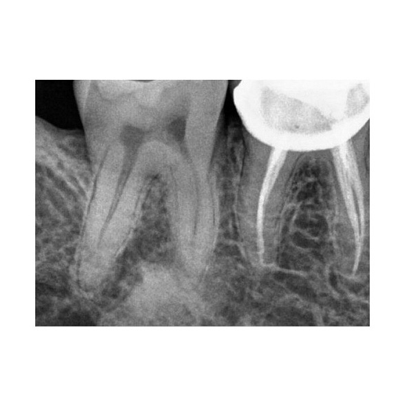 Carestream Dental RVG 5200 - радиовизиограф, 16 пар линий/мм