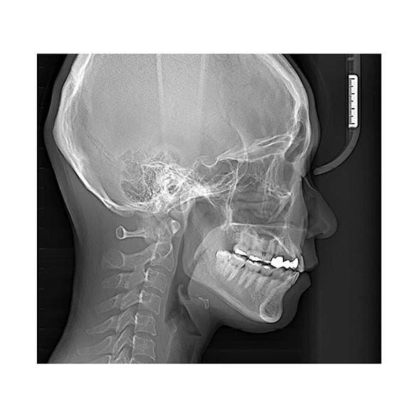 RAYSCAN Symphony Alpha 3D - ортопантомограф с компьютерным томографом, 3D 9х9 см