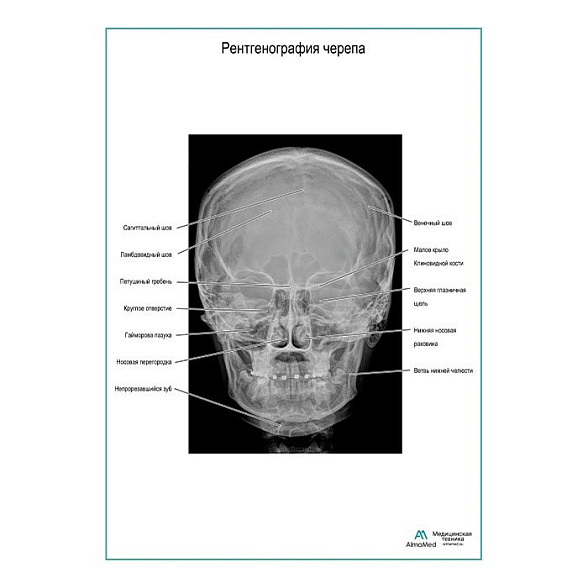 Рентгенография черепа плакат глянцевый А1+/А2+ (глянцевая фотобумага от 200 г/кв.м, размер A2+)
