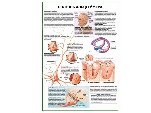 OLD Болезнь Альцгеймера плакат глянцевый А1/А2 (глянцевый A1)