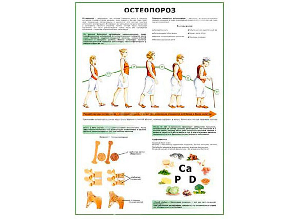 OLD Остеопороз плакат глянцевый А1/А2 (глянцевый A1)